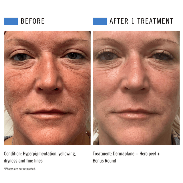 JULY SPECIAL: Peel Series at Allure Aesthetics & Beauty Co in Oregon, IL