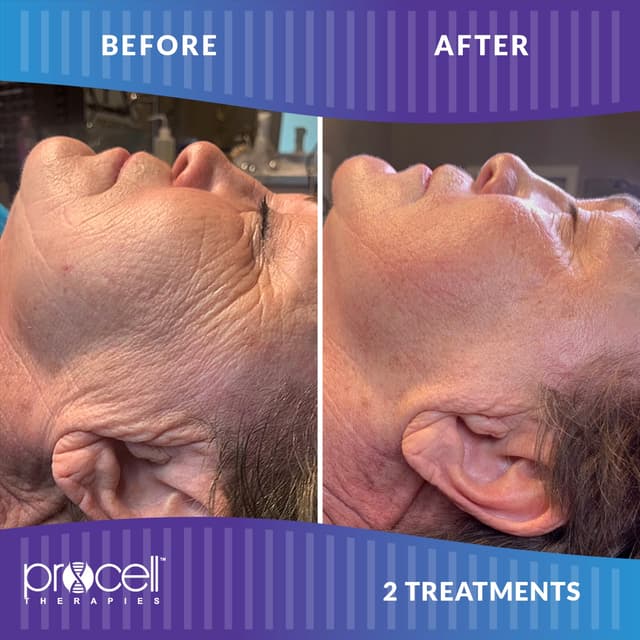 Procell Microchanneling x3 at Allure Aesthetics & Beauty Co in Oregon, IL